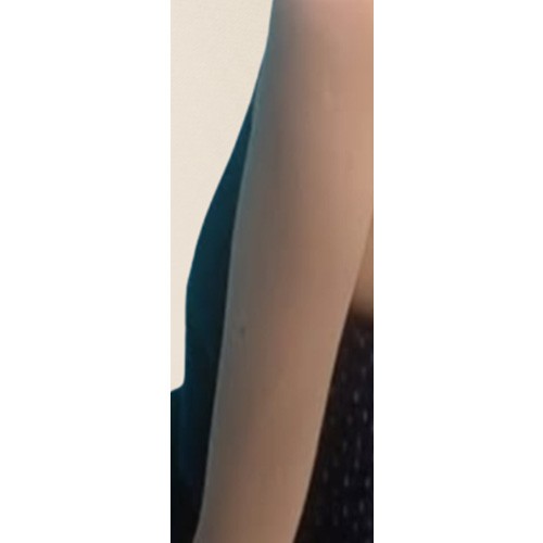 팔 카티 지방분해주사