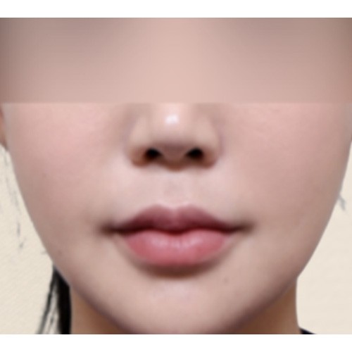 에그 볼륨 콜라겐 주사