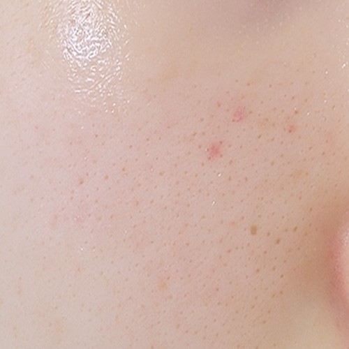 피부레이저치료