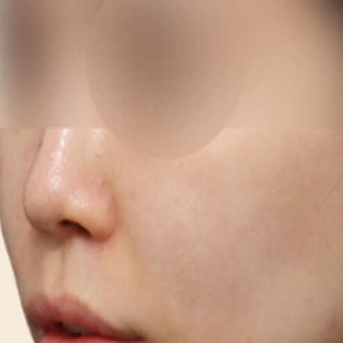 피부 부스터 치료