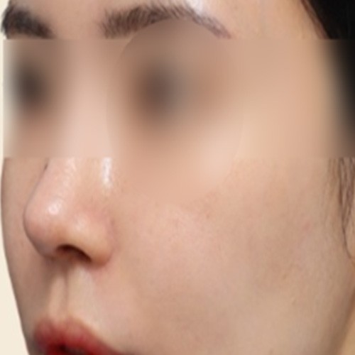 피부 부스터 치료