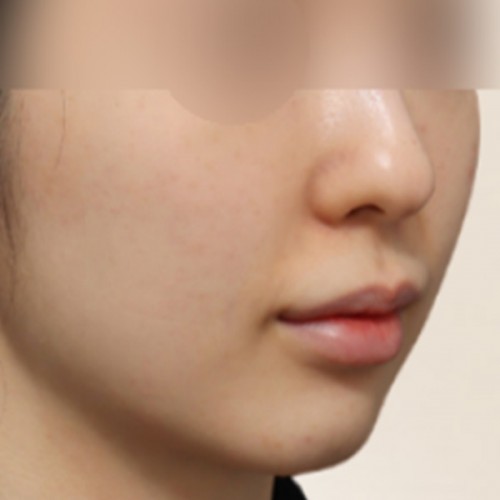 페이스 리프팅