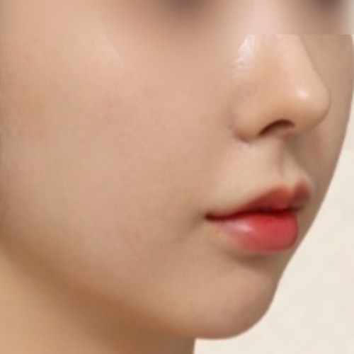 페이스 리프팅