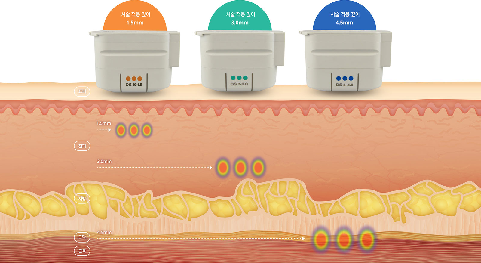 페이스 리프팅