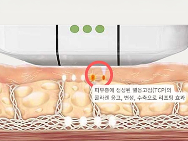 페이스 리프팅 페이스 카티주사
