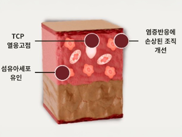 페이스 리프팅 페이스 카티주사