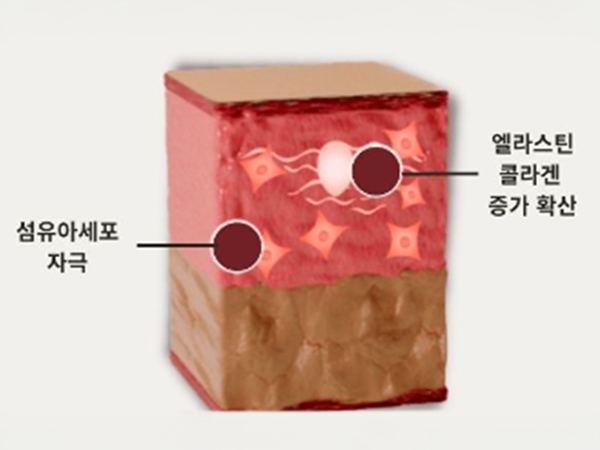 페이스 리프팅 페이스 카티주사