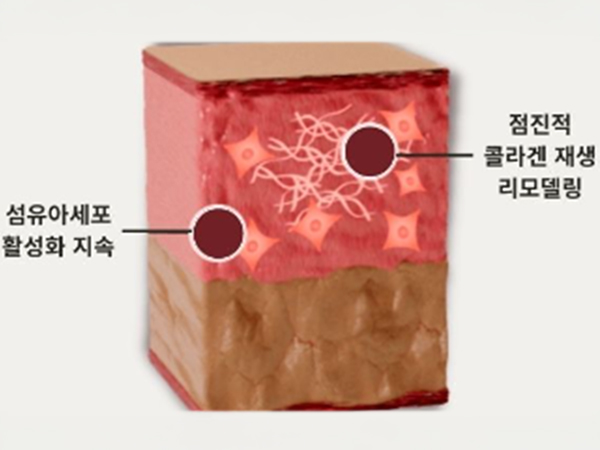 페이스 리프팅 페이스 카티주사