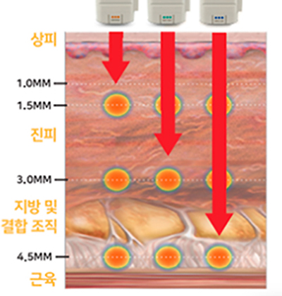 바디 리프팅